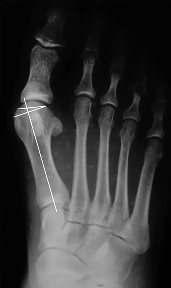 Röntgen chodidla pri hallux valgus