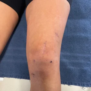 Rehabilitácia kolena po rekonštrukcii predného skríženého väzu