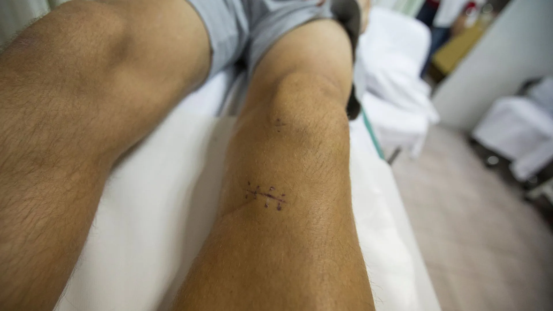 Rehabilitácia po rekonštrukcii predného skríženého väzu (ACL)
